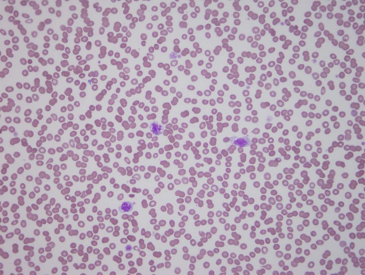 Giant platelets in the peripheral blood
